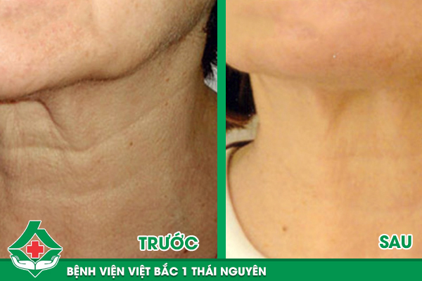 Kết quả khách hàng thực hiện căng da trán/ cổ/ thái dương tại Bệnh viện Việt Bắc 1