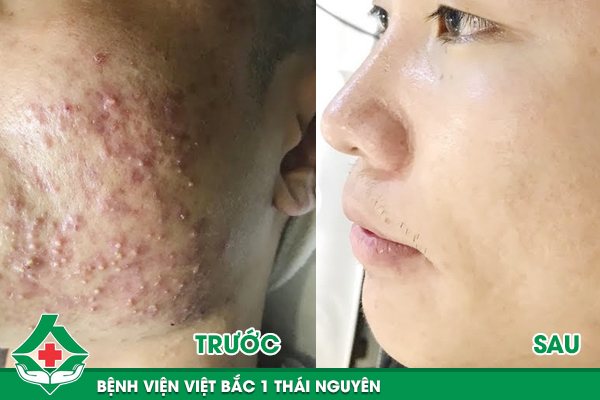 Kết quả khách hàng thực tế sau 6 buổi điều trị mụn tại Bệnh viện Việt Bắc 1