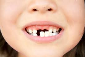 Sâu răng: Triệu chứng, chẩn đoán và điều trị Hello Bacsi