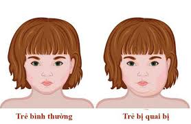 Dấu hiệu quai bị ở trẻ em mà cha mẹ cần biết - Bệnh viện Đa khoa Phương ĐôngBệnh viện Đa khoa Phương Đông
