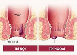 Bệnh trĩ: Nguyên nhân, dấu hiệu và cách chữa - Phòng khám phụ khoa bắc giang