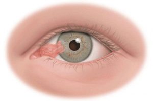 Các bệnh mắt thường gặp thumbnail