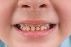 Cảnh báo nguy cơ – Sâu răng ở trẻ em thumbnail