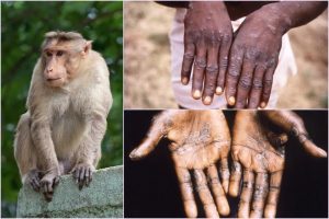 Những Điều Cần Biết Về Bệnh Đậu Mùa Khỉ thumbnail