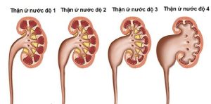 THẬN Ứ NƯỚC DO SỎI: LÝ GIẢI NGUYÊN NHÂN VÀ CÁCH ĐIỀU TRỊ