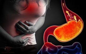 Trào Ngược Dạ Dày: Nguyên Nhân, Triệu Chứng và Cách Điều Trị Hiệu Quả